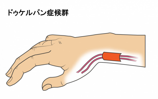 腱鞘炎とは?