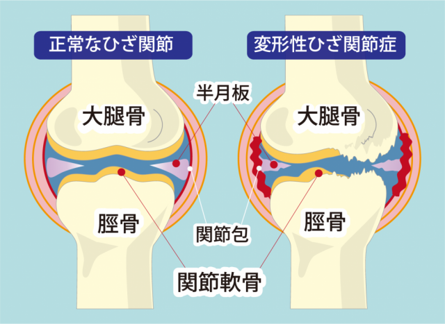 膝関節のイラスト