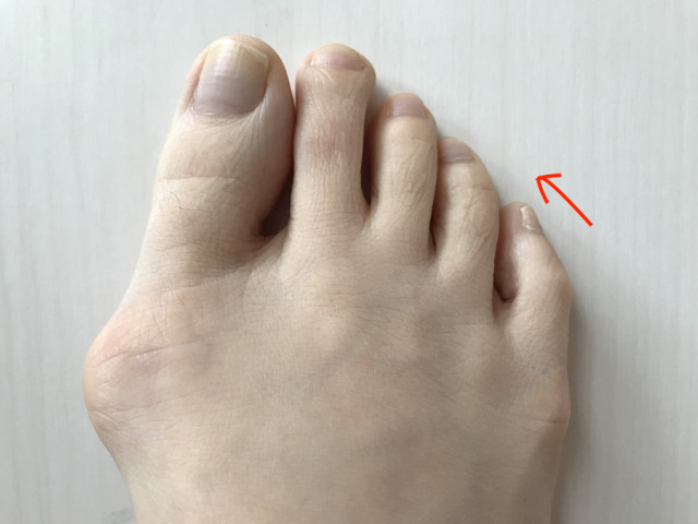 内反小趾とは?